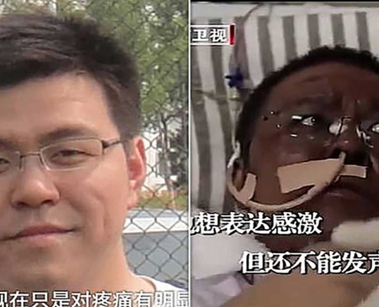 وفاة طبيب ووهان الذي تغير لون وجهه بسبب علاج لكورونا