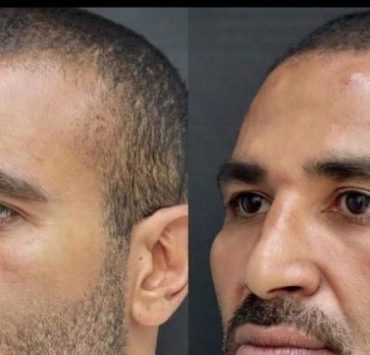 أحمد سعد : يرد عملية التجميل مجرد فيلر