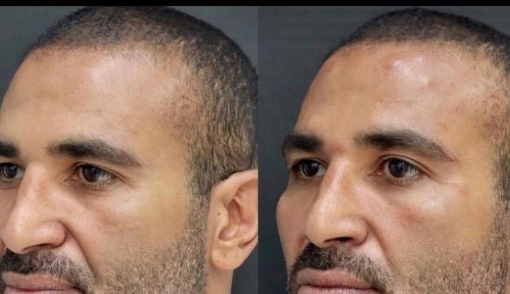 أحمد سعد : يرد عملية التجميل مجرد فيلر