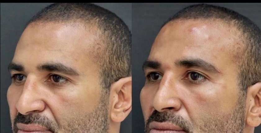 أحمد سعد : يرد عملية التجميل مجرد فيلر