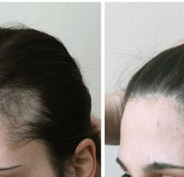 كل ما يجب أن تعرفونه على زراعة الشعر للسيدات والرجال
