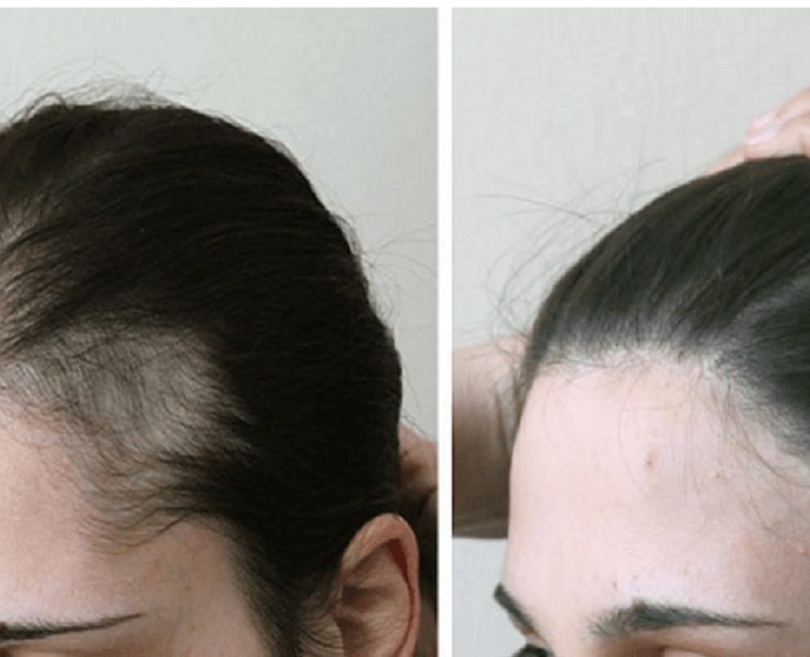 كل ما يجب أن تعرفونه على زراعة الشعر للسيدات والرجال